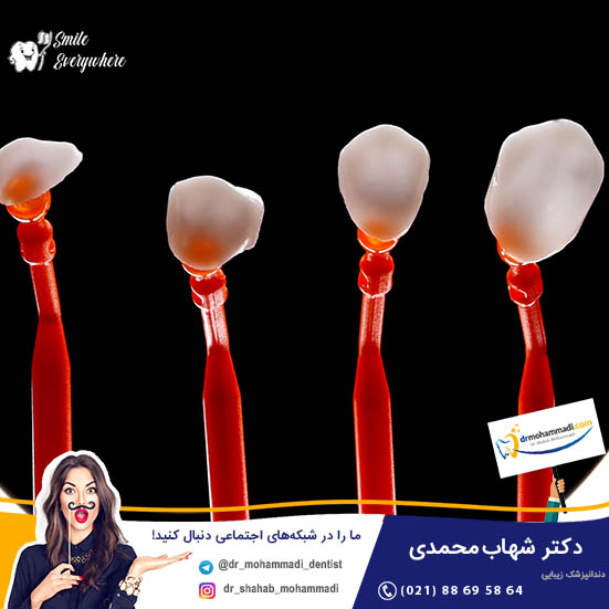 مزایا و کاربرد لمینت ای پی اس و مراقبت های بعد از آن - کلینیک دندانپزشکی دکتر شهاب محمدی
